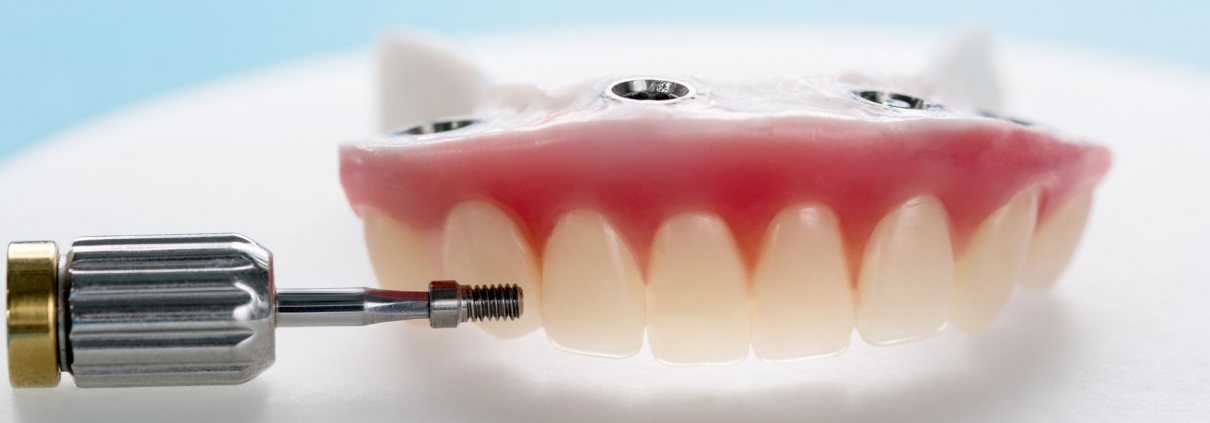 implant-supported-dentures