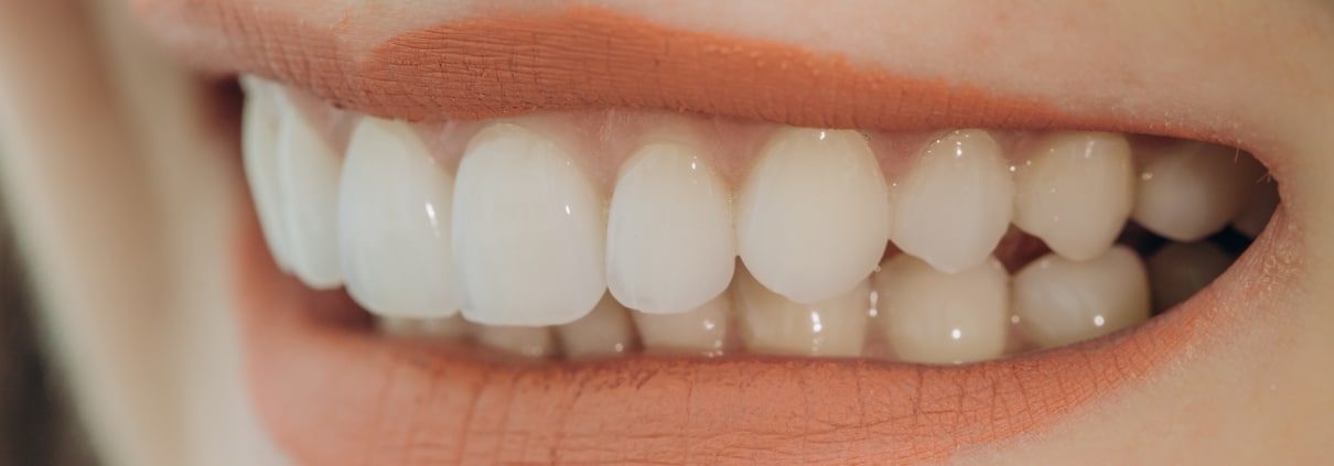 Hollywood smile with porcelain crowns and veneers