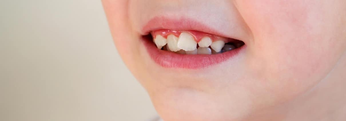 child-has-crooked-teeth-concept-crowding-molars
