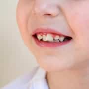 child-has-crooked-teeth-concept-crowding-molars
