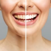 woman-teeth-before-after-whitening-white-background-dental-clinic-patient-image-symbolizes-oral-care-dentistry-stomatology