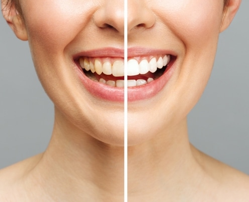 woman-teeth-before-after-whitening-white-background-dental-clinic-patient-image-symbolizes-oral-care-dentistry-stomatology