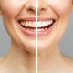 woman-teeth-before-after-whitening-white-background-dental-clinic-patient-image-symbolizes-oral-care-dentistry-stomatology