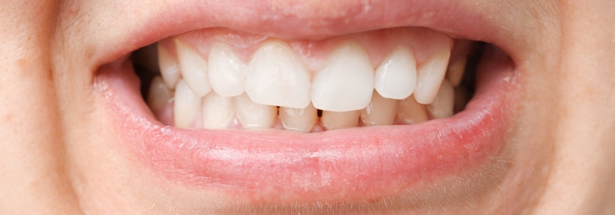 Mouth with white teeth, malocclusion, health problem. Close-up occlusion, misalignment.
