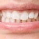 Mouth with white teeth, malocclusion, health problem. Close-up occlusion, misalignment.