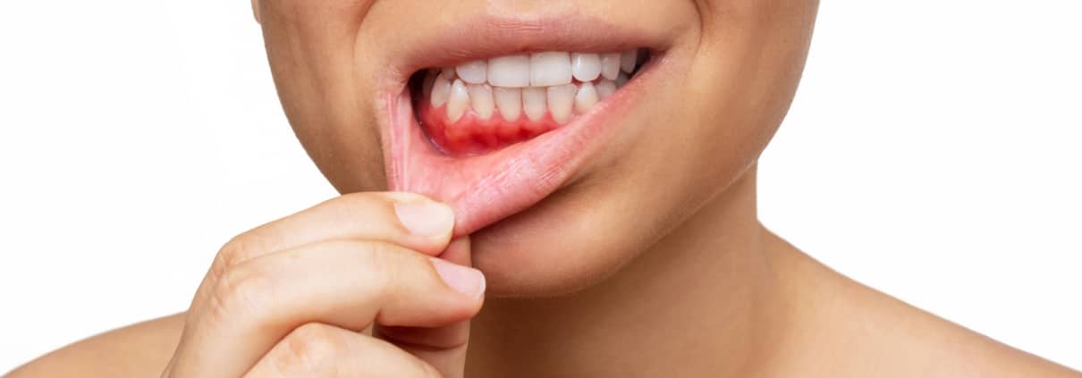Gum inflammation. Cropped shot of a young woman shows red bleeding gums pulling the lip