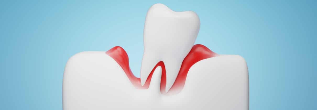 gums and teeth disease