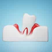 gums and teeth disease